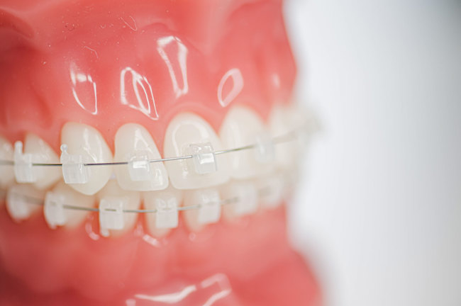 Festsitzende Zahnspange Orthodontics