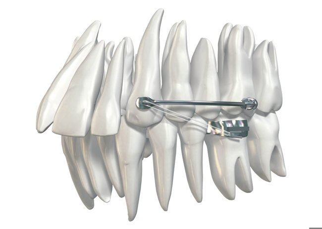 Carriere Distalizer